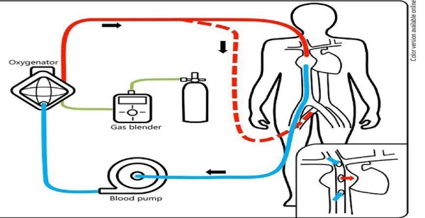 心肺轉(zhuǎn)流術(shù) 心肺轉(zhuǎn)流術(shù)